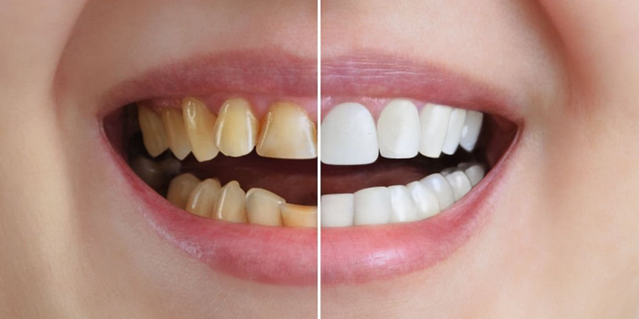 Diş Beyazlatma İşlemi ve Diş Beyazlatmanın Riskleri Nelerdir?