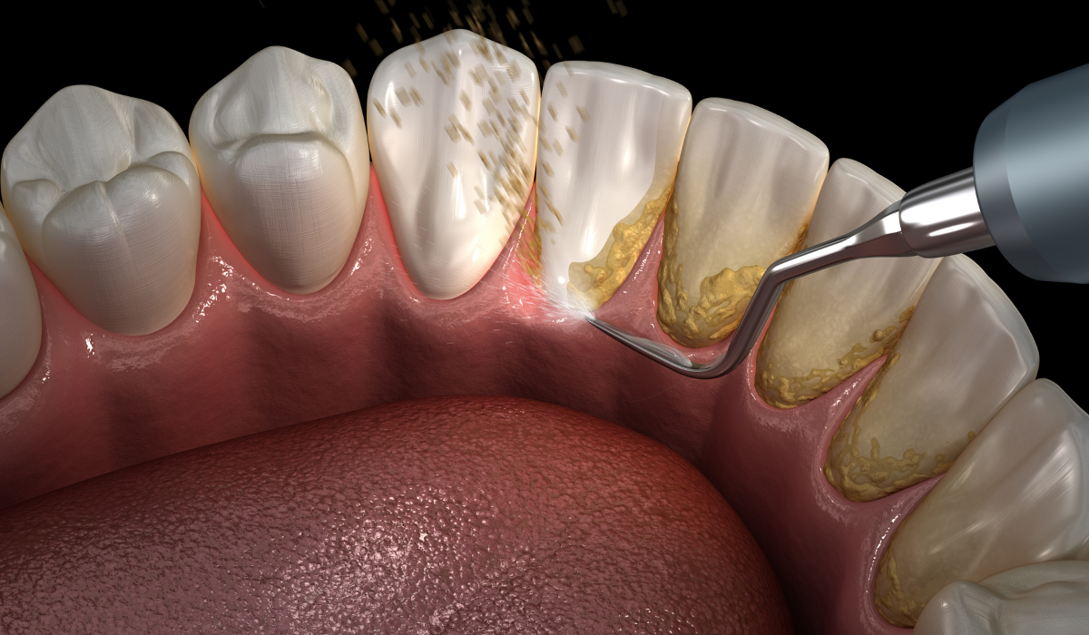 Diş-Taşı-Temizletme-Ağız-Sağlığınız-İçin-Neden-Önemlidir