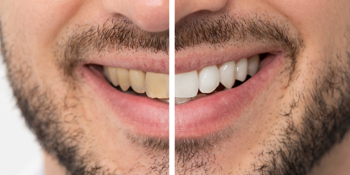 What-is-Teeth-Whitening-and-How-does-It-Work